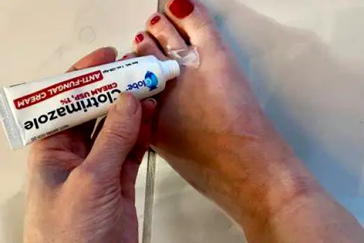 Hands applying white antifungal cream to the skin between the toes of a freshly washed, dried foot