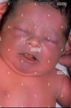 A baby with noticeably blue lips