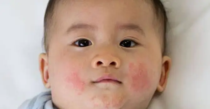 Baby lying on back with dampness visible in the neck fold from drool or milk residue