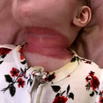 Baby Neck Yeast Infection: Signs, Care, and When to Call a Doctor