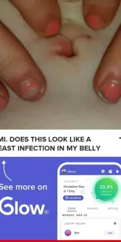 Belly Button Yeast Infection: What the Rash May Look Like