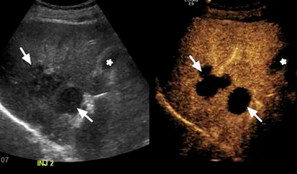 Ultrasound screen displaying various benign liver abnormalities such as cysts and hemangiomas