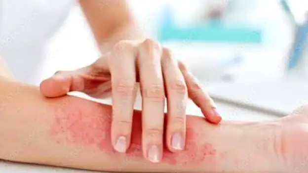 Clinician in a white coat closely examining a red rash on a patient's forearm in an exam room