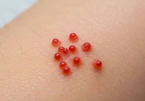 A cluster of small red bumps on skin, typical of flea or bed bug bites