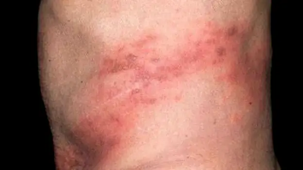 A cool, wet compress held against an area of shingles rash