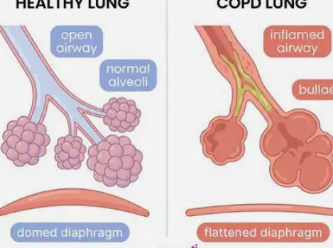 Lungs showing hyperinflated air sacs, damaged alveoli, and mucus-obstructed airways in COPD