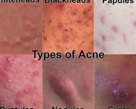 What Cystic Acne Looks Like and When to Seek Treatment