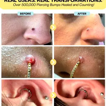 Dermatologist administering a corticosteroid injection into a raised keloid scar next to a nose piercing.