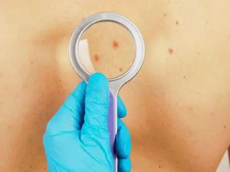 Dermatologist examining a small skin growth on a patient's neck using a handheld dermatoscope in a clinical setting