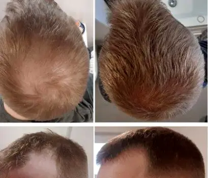 Can Finasteride Regrow Hair? Results, Timing, and Limits