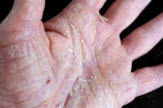 Close-up of a hand showing dry, flaky skin with visible peeling and tightness