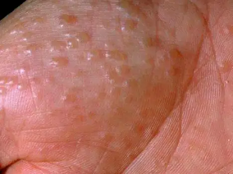 Multiple small deep-seated blisters clustered on the palm and along the sides of the fingers