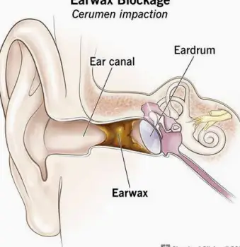 Close-up view of an ear canal with a visible earwax buildup narrowing the passage
