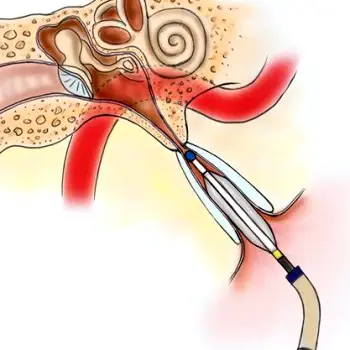 Side cutaway of a human ear showing the eardrum, middle ear space, and narrow eustachian tube connecting to the back of the nose and throat