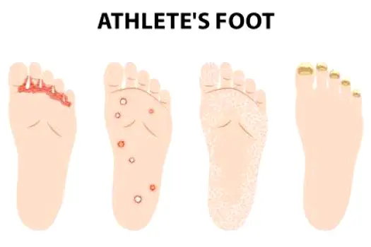 Close-up of red, scaly, peeling skin between the toes of a foot