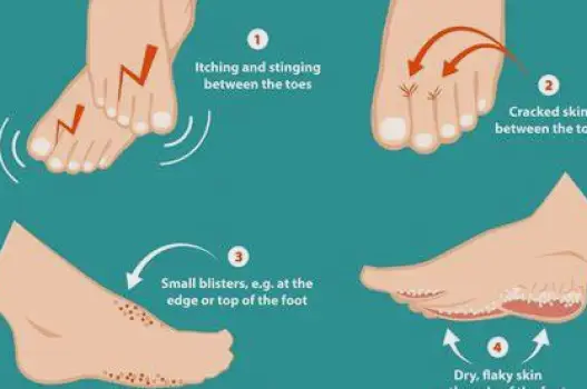 How to Treat Early-Stage Athlete's Foot Before It Spreads