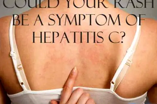 Early-Stage Hepatitis Rash: Patterns, Clues, and Next Steps