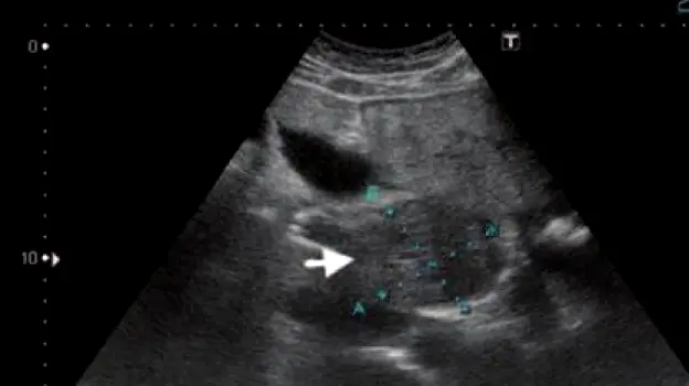 Early-Stage Liver Cancer on Ultrasound: Findings and Next Steps