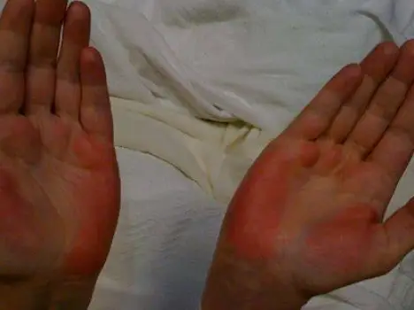 Red Palms and Liver Disease: What Photos Can-and Cannot-Tell You