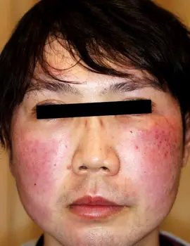 Can an Early Facial Rash Be a Sign of Mononucleosis?