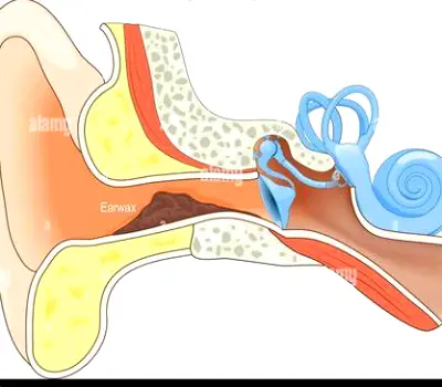 Close view of a natural earwax buildup forming a physical barrier inside the outer ear canal