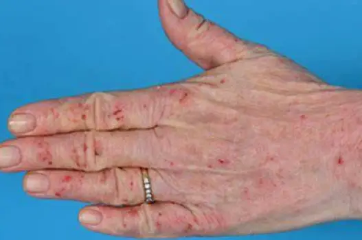 What Hand Eczema Looks Like Across Types and Skin Tones