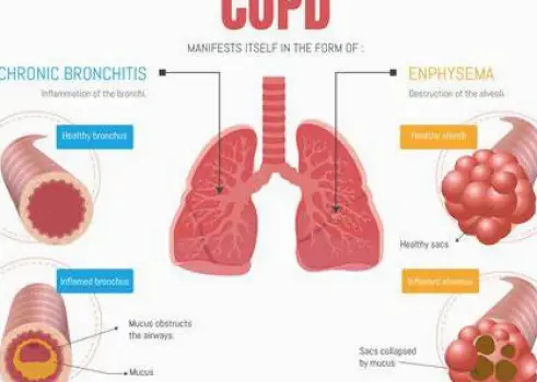 End-Stage COPD: Lung Changes, Symptoms, Care, and Outlook