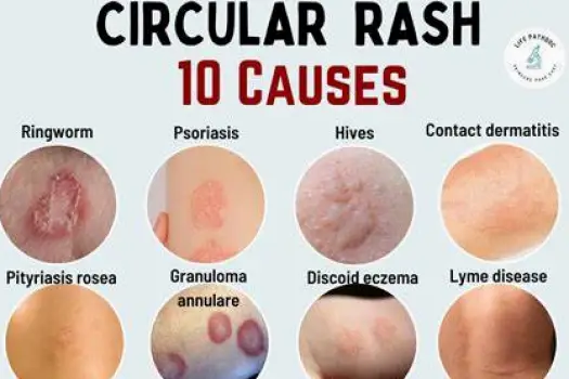 Expanding circular pink or red rash on skin with uneven color and no clear center