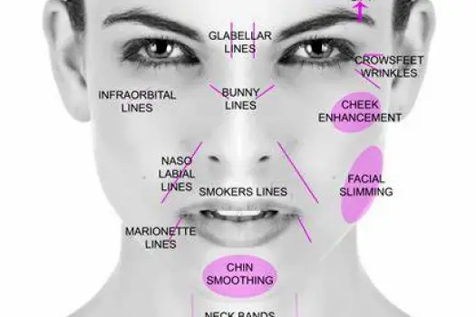 Close-up of a person's face showing fine lines around the eyes caused by smiling and repeated facial movement