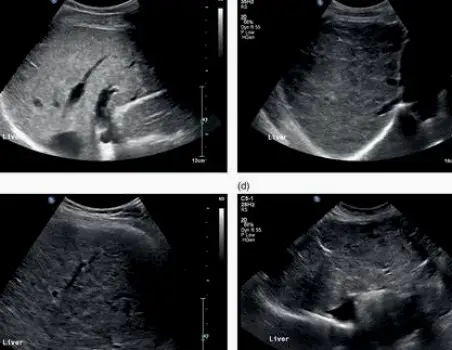 Diagram illustrating how body habitus and liver nodularity can obscure ultrasound visualization