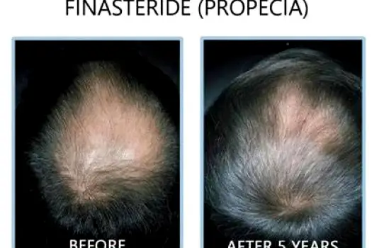 Finasteride Before and After: Results, Timeline, and Limits