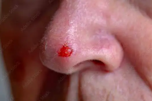 Why a Flat Red Spot on Your Nose May Not Be Going Away
