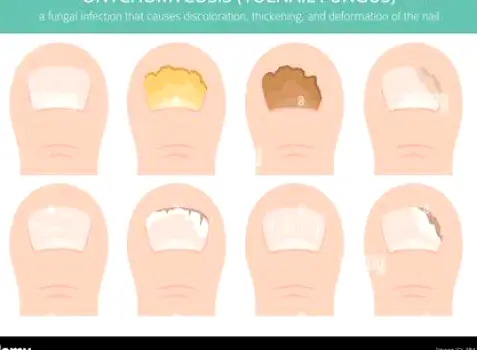 Close-up of toenails thickened, yellowed, and crumbling from fungal infection spread from athlete's foot