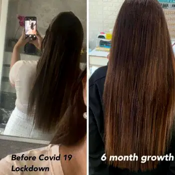 Close-up of newly grown hair emerging from the scalp six months after transplantation