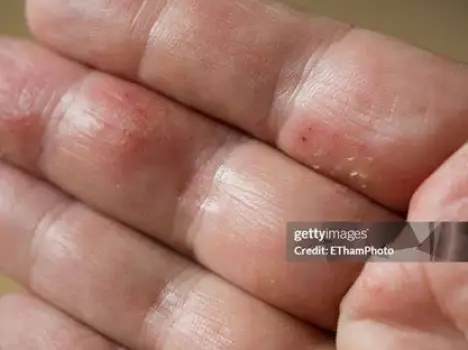 Palm and dorsal view of hands with eczema affecting the palms, sides of fingers, finger webs, and wrists
