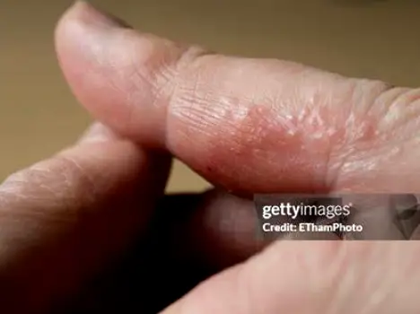 Hand during an active flare showing weeping blisters, crusting, scaling, and a painful fissure on the fingertip