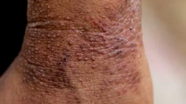 Hand with darker skin tone showing eczema inflammation as brownish-purple patches with thickened skin and prominent follicles
