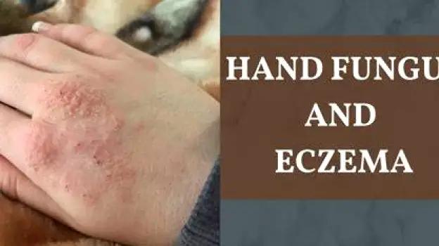 Hand Fungus or Eczema: How to Recognize the Differences