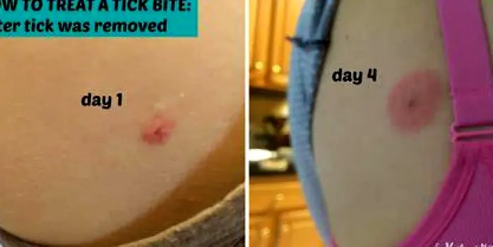 Small healing mark on skin after tick removal with slight redness and no expansion