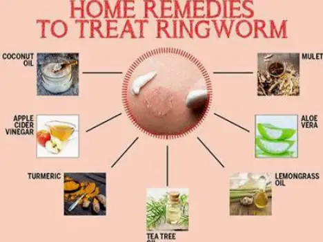 Ringworm Home Care: What Works, What Does Not, and When to Get Help