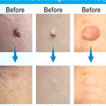 How Much Does Skin Tag Removal Cost in the United States?
