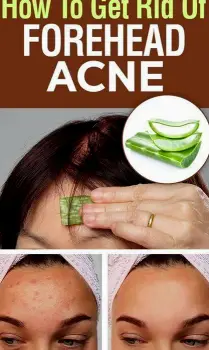 How to Clear Forehead Acne and Identify Stubborn Bumps
