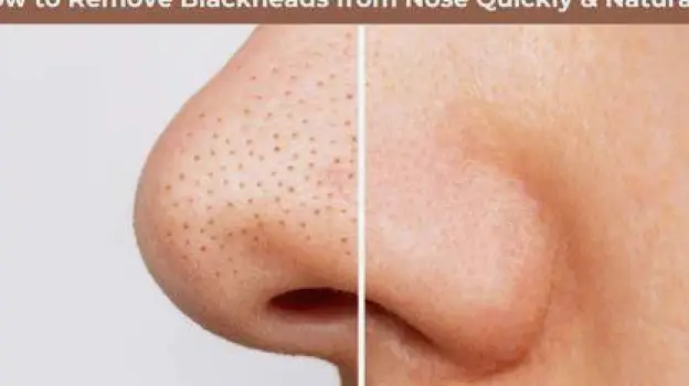 How to Safely Clear Blackheads on Your Nose