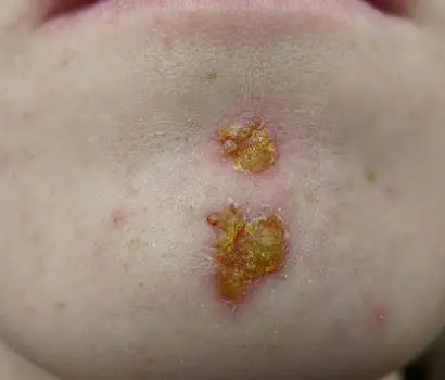 Facial skin lesion with honey-colored crusting typical of impetigo near the nose or mouth