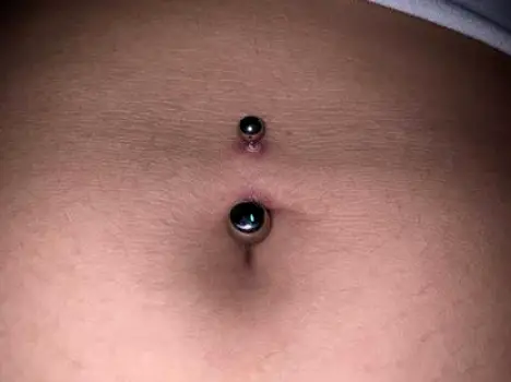 Close-up of a belly button piercing on darker skin showing purple and deep brown discoloration and swelling around the jewelry.