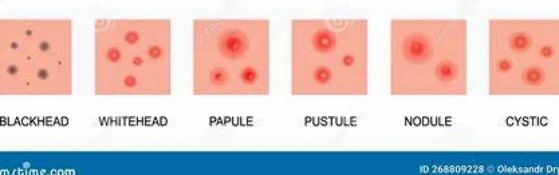 Close-up view of skin showing red inflamed papules and pustules characteristic of moderate inflammatory acne