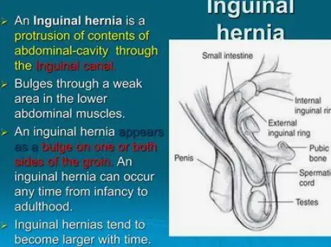 Close-up of a bulging hernia in the groin area, with the lump becoming prominent during coughing, as described in the text