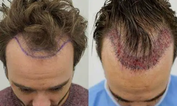 Are Hair Transplant Results Permanent? What Really Lasts