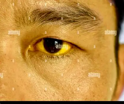 Close-up of a person's face showing yellowing of the skin and eyes indicative of jaundice