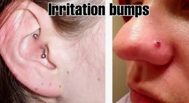 Nose Piercing Bump or Keloid? How to Tell and What to Do